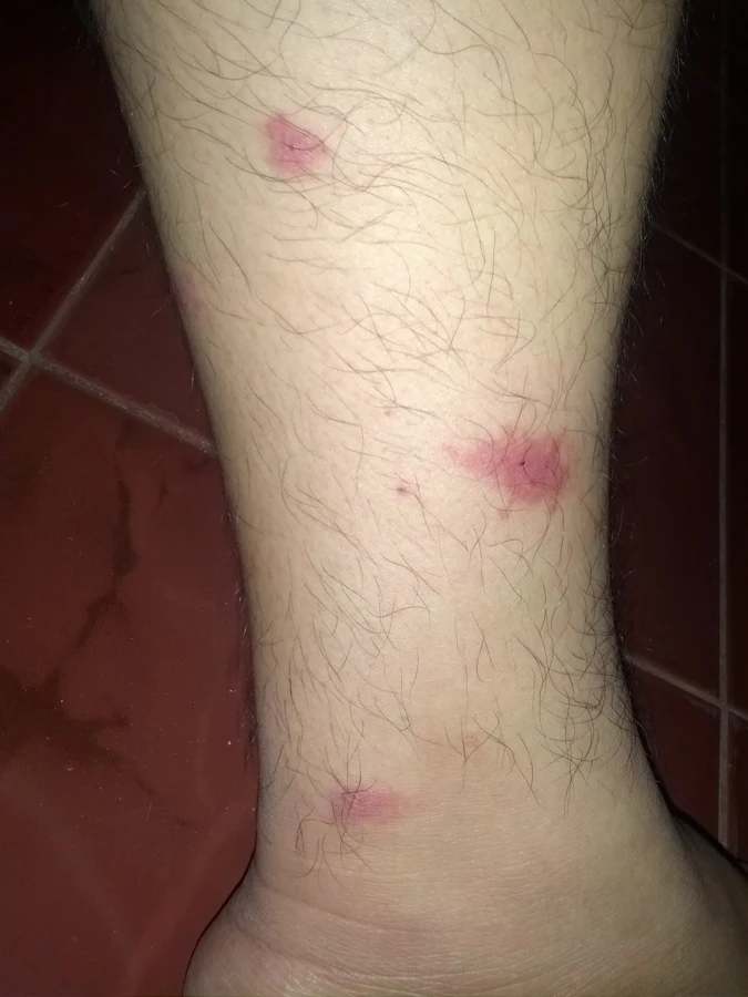 Plusieurs piqûres de moustique rouges et gonflées sur le bas de la jambe près de la cheville