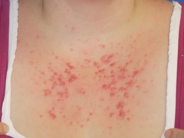 Petits boutons rouges groupés sur le décolleté, aspect typique d'une lucite après une exposition au soleil