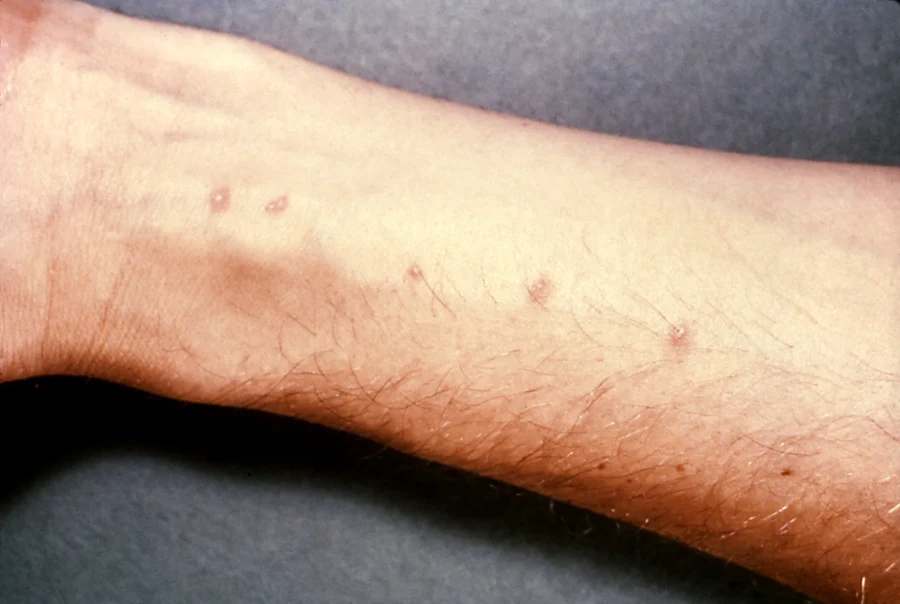 Petits boutons rouges espacés sur l'avant-bras après une baignade, aspect d'une dermatite cercarienne